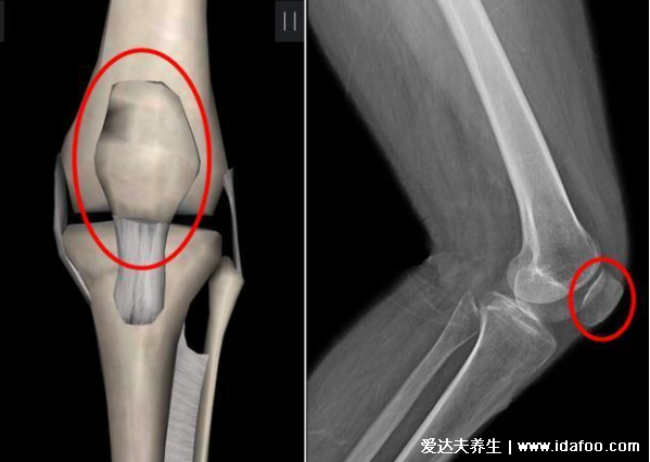 半月板是什么部位圖片，位于膝關節(jié)的內外兩側起緩沖作用