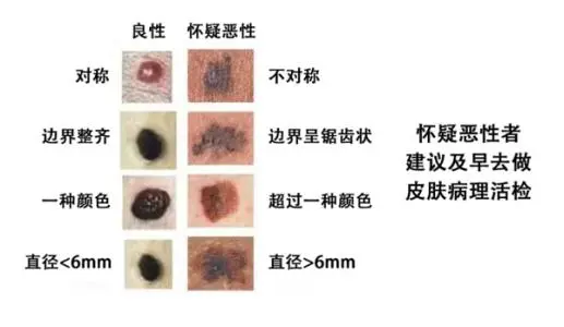 黑色素瘤早期癥狀圖片，看顏色/大小/形狀（鋸齒狀直徑大5毫米） 