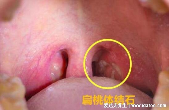 扁桃體結(jié)石脫落小妙招圖片，口腔里吐出了個(gè)小黃粒巨臭