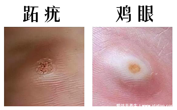 眼瞼脖子和腋下長的小肉粒是什么，到底是不是感染HPV病毒