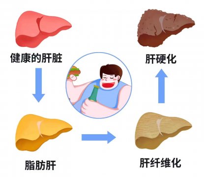 堅持三個護肝秘訣，有效改善肥胖性脂肪肝對身體的危害