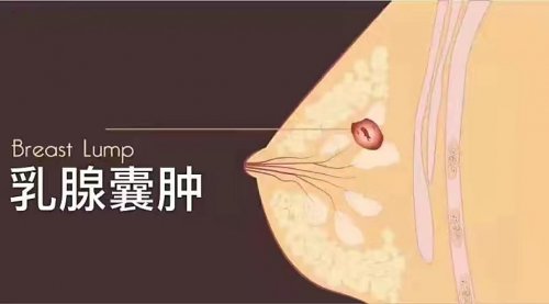 乳腺囊腫會(huì)變成乳腺癌嗎