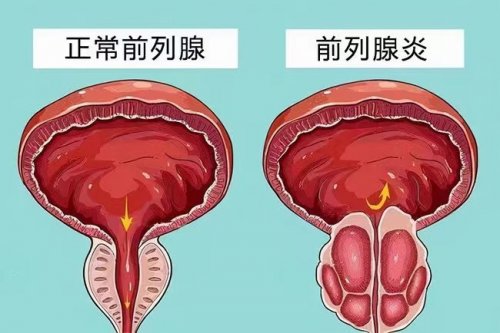 番茄是前列腺炎的死對(duì)頭男人多吃點(diǎn)有助延長(zhǎng)生命腺