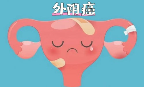 23歲女子確診外陰癌5個(gè)壞習(xí)慣要盡早改