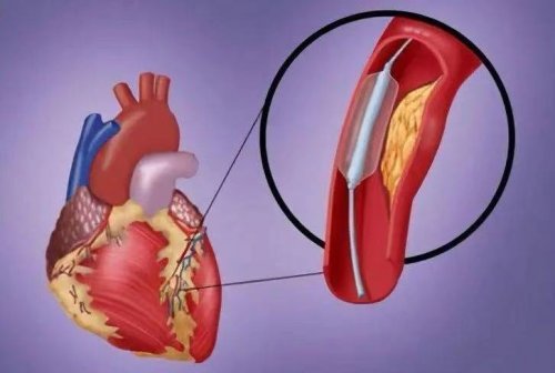 心絞痛患者到底應(yīng)該裝心臟支架嗎