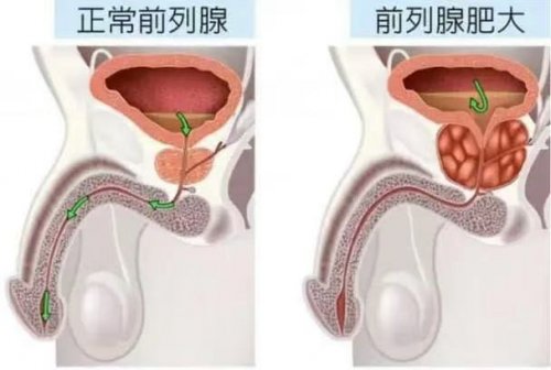 男人逃不掉的麻煩前列腺變大這5個(gè)習(xí)慣要當(dāng)心